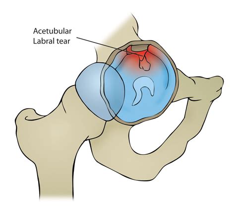 right hip pain icd 10|right hip labral tear icd 10.